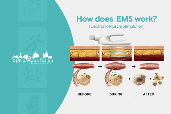 EMS treatment for post pregnancy weight loss treatment Hounslow