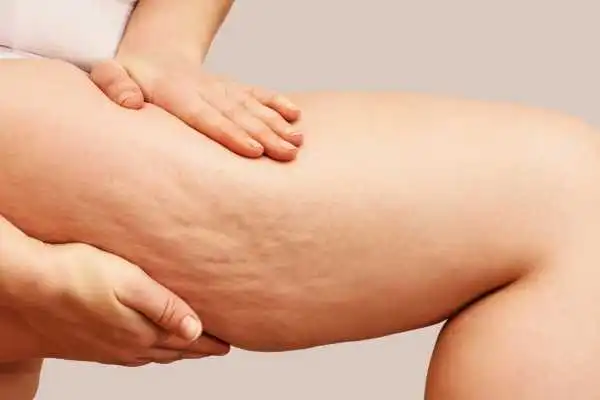 Image of woman showing leg with cellulite Hounslow