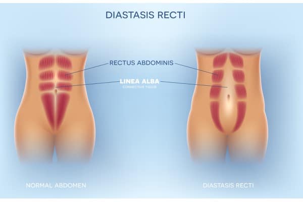 What Non-Surgical Options Are Available for Diastasis Recti Hounslow?