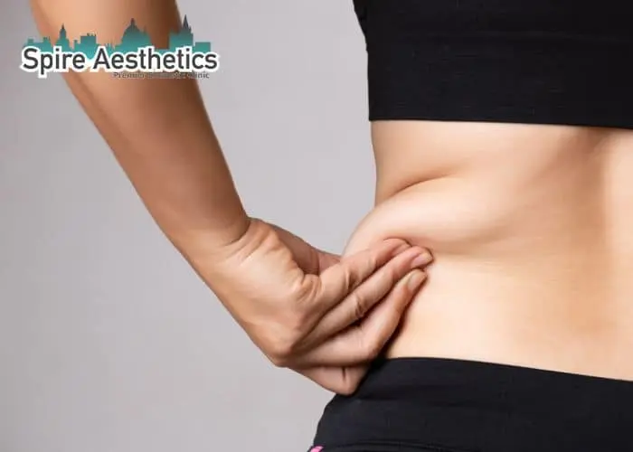 Image of woman pinching fat on their hips Hounslow. Fat Freezing treatment