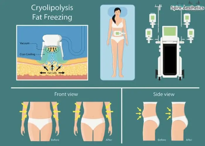 Fat freezing treatment Hounslow benefits for competitions to remove stubborn fat deposits.