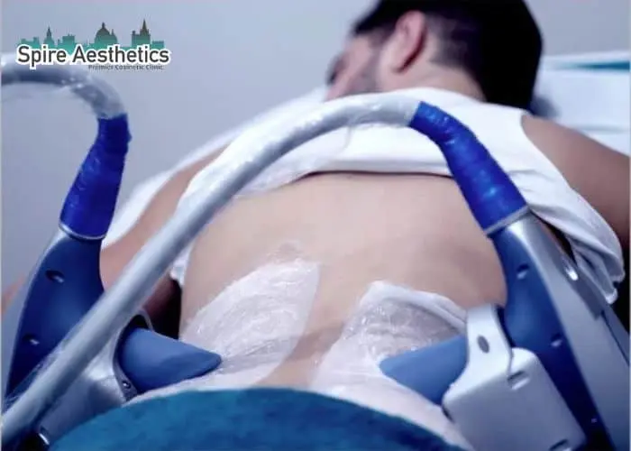 Man having fat freezing treatment done on love handles before a competitions Hounslow to create a sculpted look.