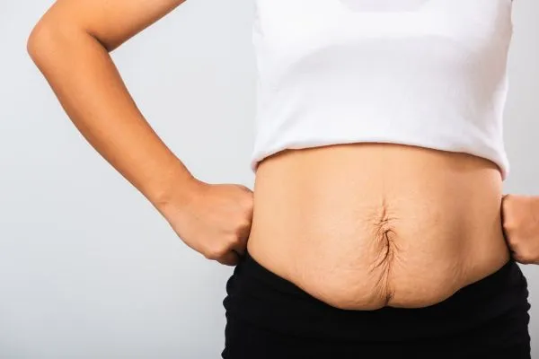 Image of a woman's stomach after weight loss with sagging skin following a gastric band Hounslow