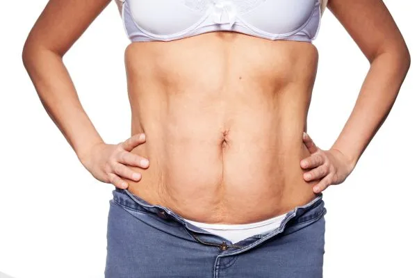 sagging skin on woman's stomach after weight loss injections Hounslow