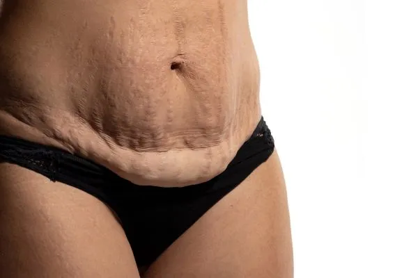 Image of womans stomach after weight loss injections Hounslow showing saggy skin