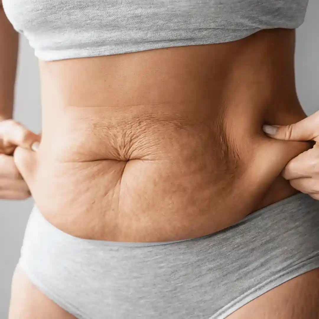 Is It Normal to Have Loose Skin After Pregnancy Hounslow?