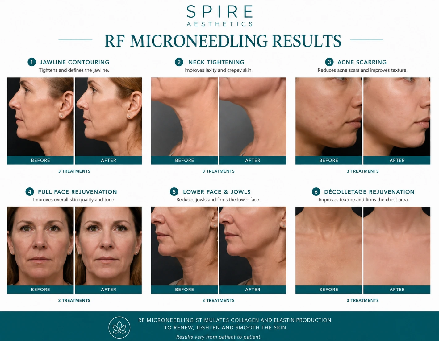 RF Microneedling Skin tightening Hounslow results