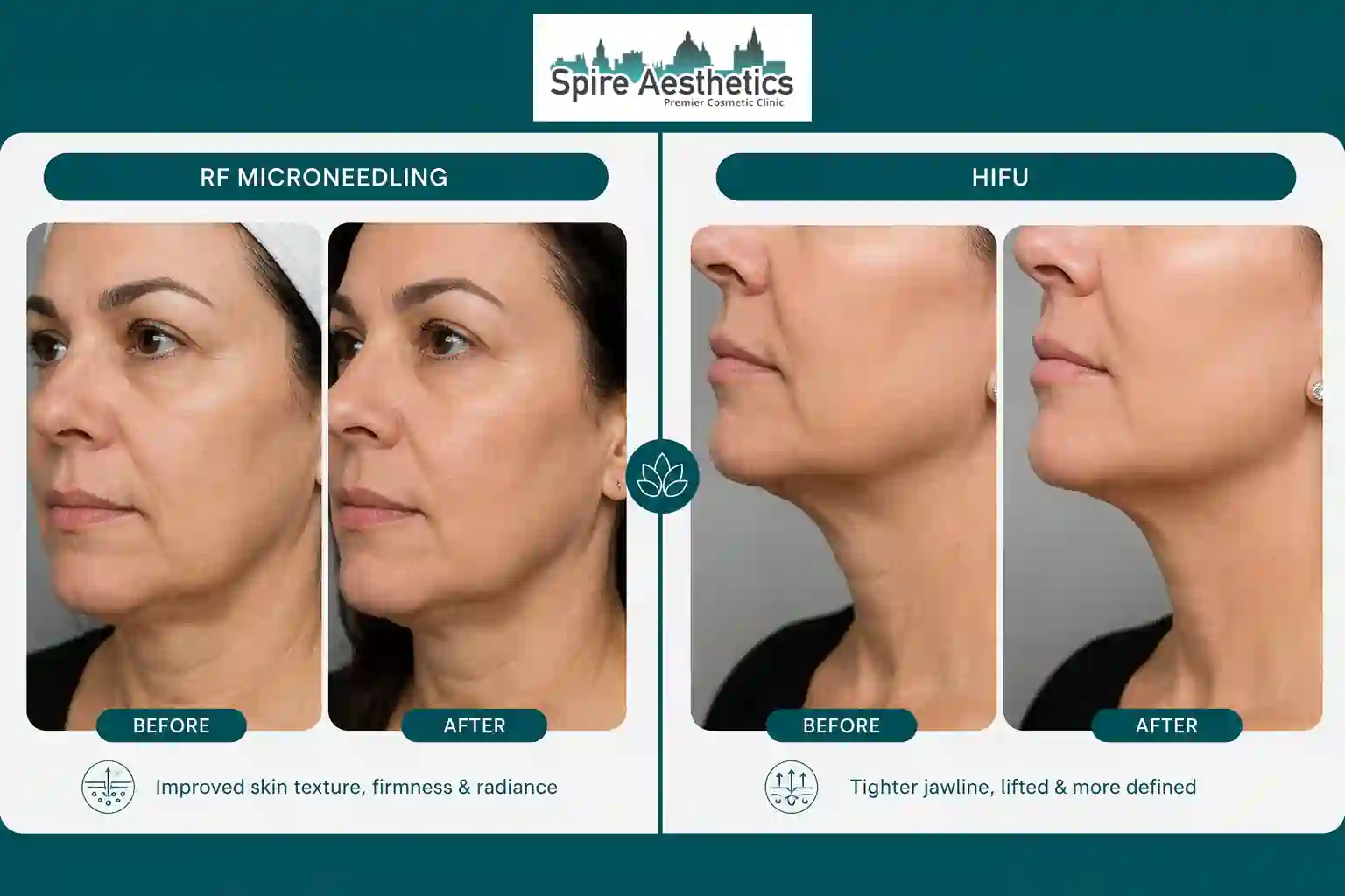 Can RF Microneedling and HIFU Be Combined Hounslow?