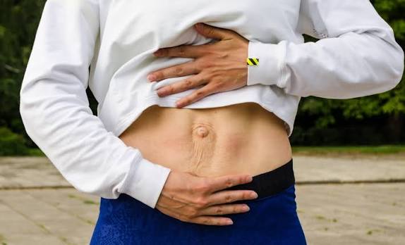 When Could Diastasis Recti Be the Missing Piece of the Puzzle Hounslow?